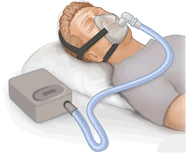 What is CPAP (Continuous Positive Airway Pressure) Therapy?